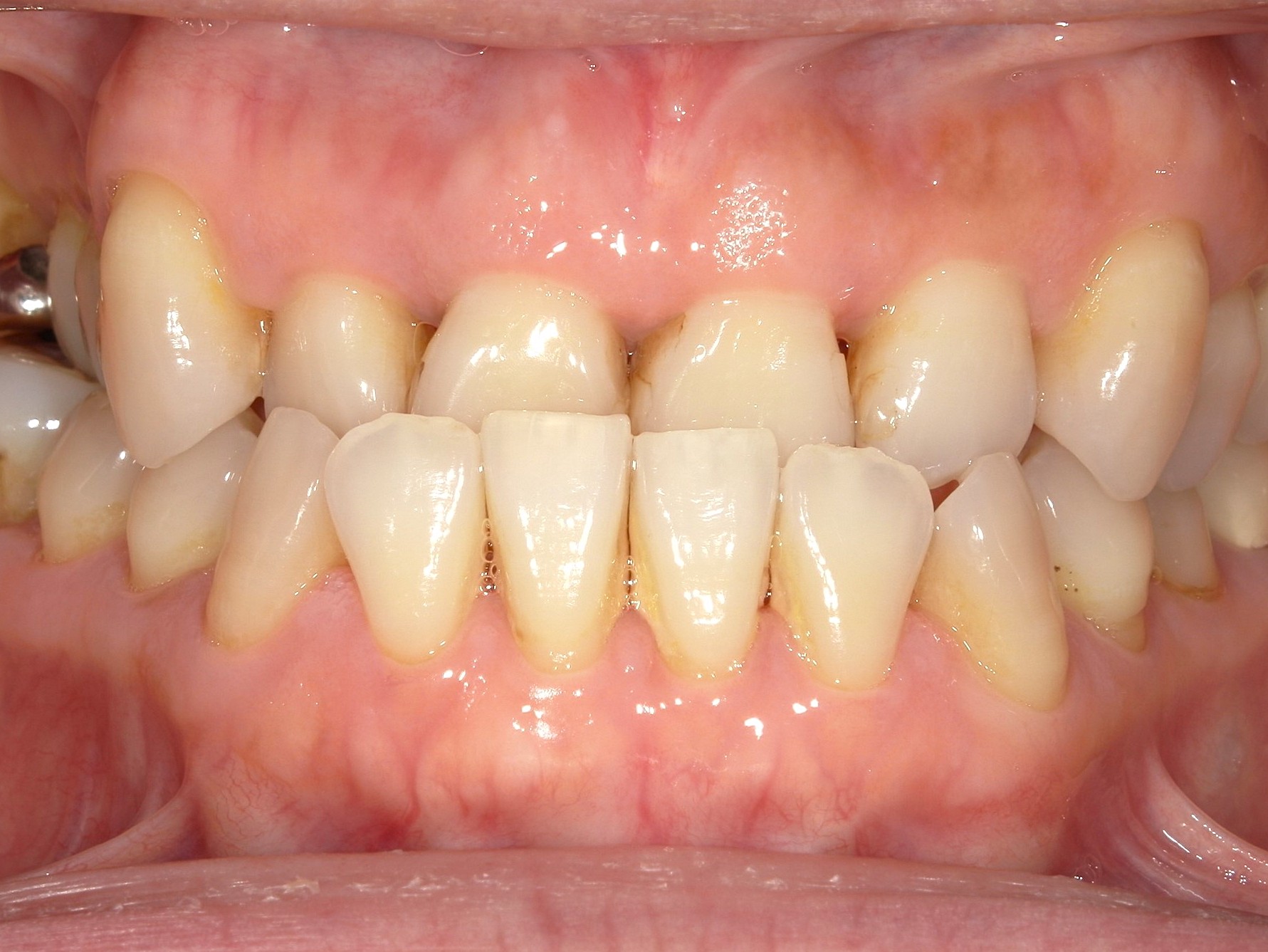 マウスピース矯正　反対咬合（受け口）