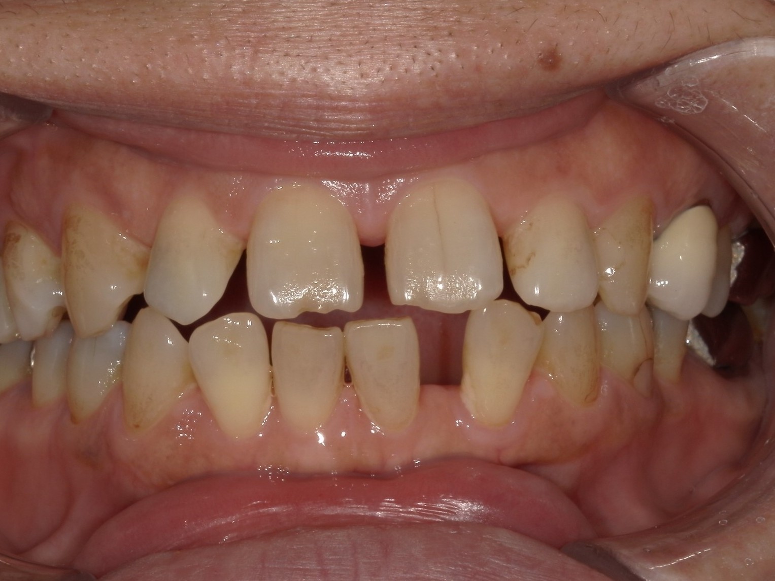 インビザライン　オープンバイト・すきっ歯