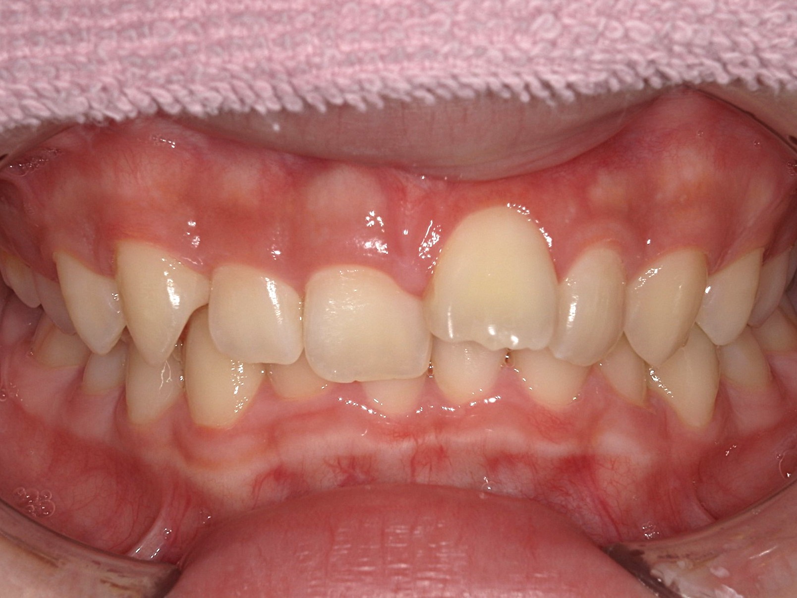 インビザライン　歯並びが気になる（1本出っ歯）