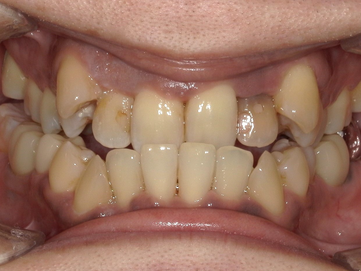 叢生　反対咬合　インビザライン　歯科矯正