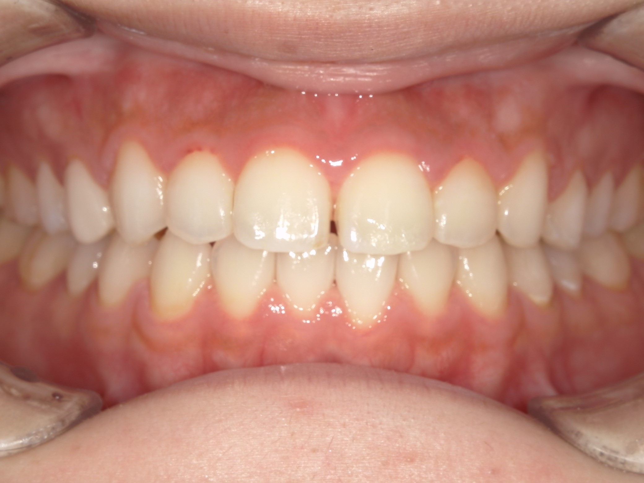 インビザライン　正中離開（すきっ歯）札幌