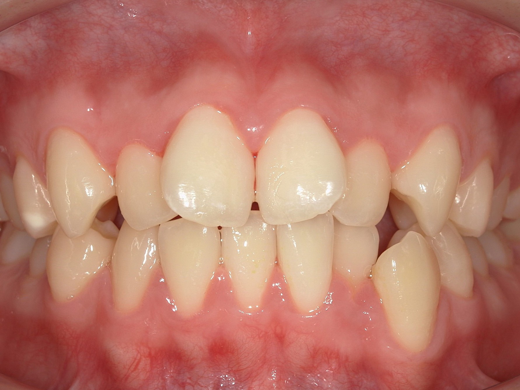 インビザライン　歯並びが気になる　叢生　ガタガタ歯並び