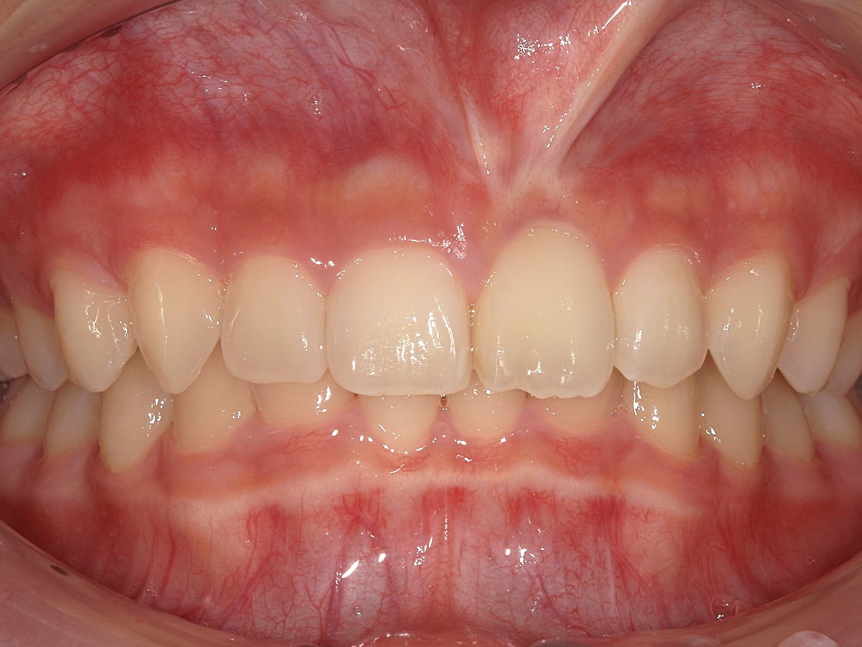 インビザライン　歯並びが気になる（1本出っ歯）