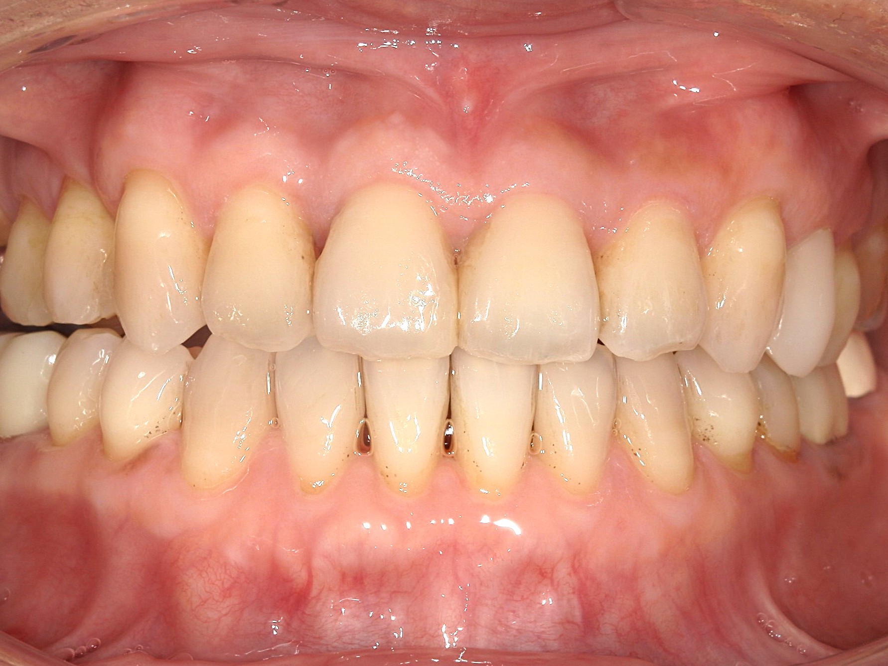 マウスピース矯正　反対咬合（受け口）