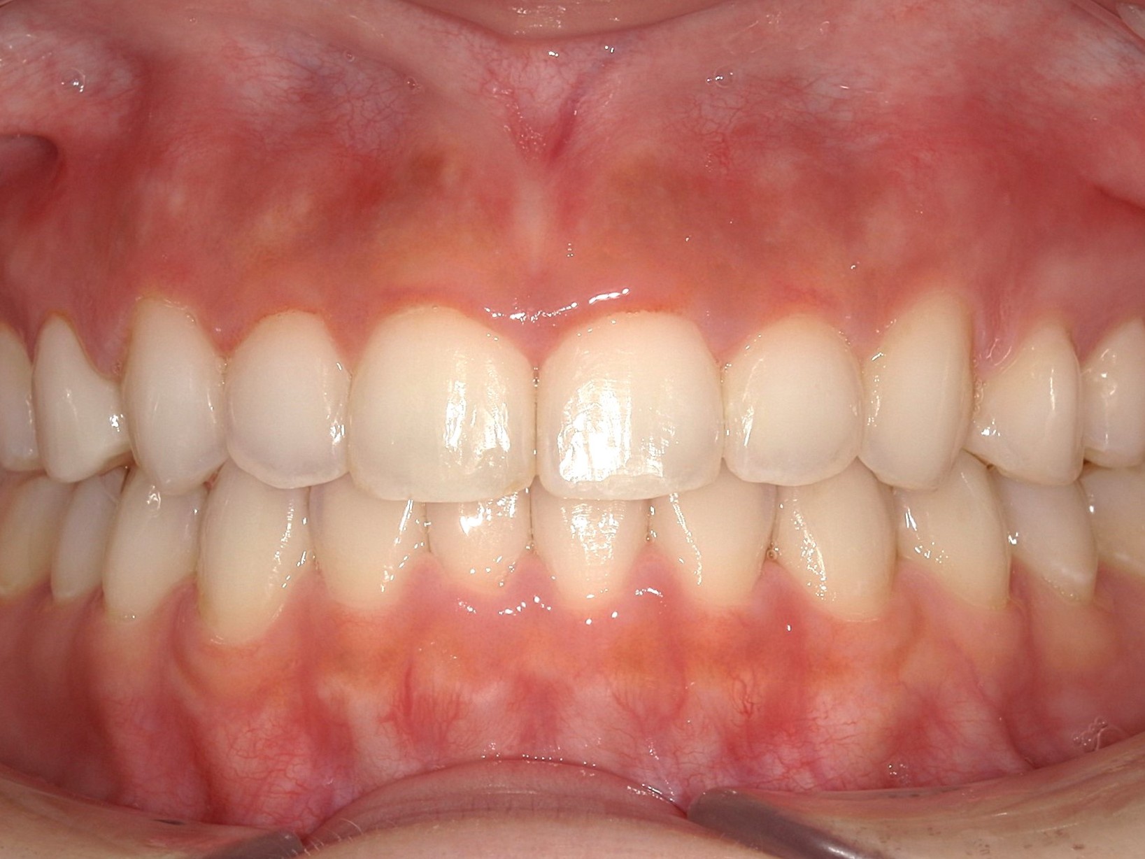 インビザライン　正中離開（すきっ歯）札幌
