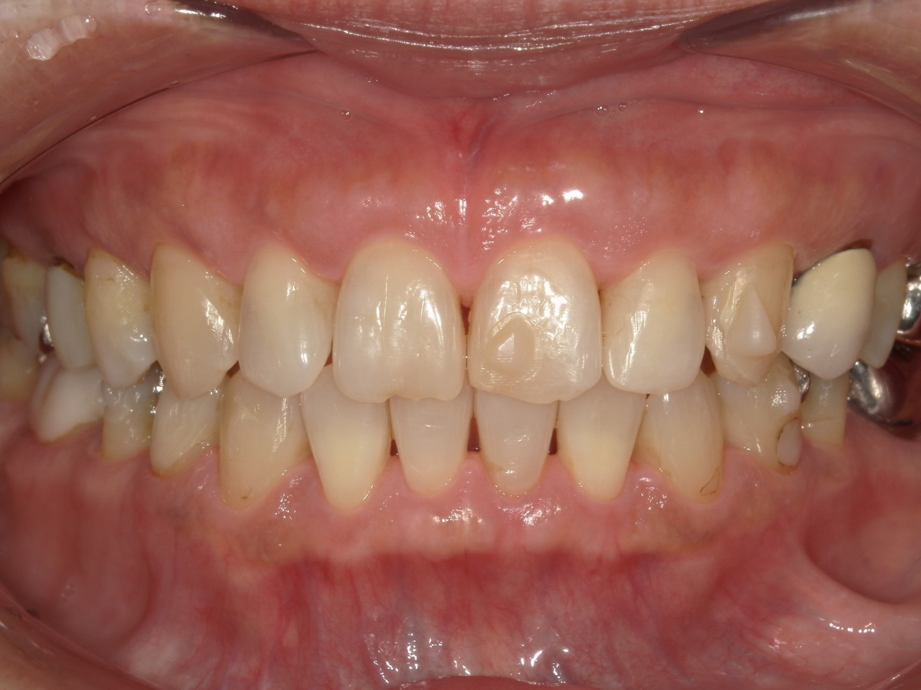 インビザライン　オープンバイト・すきっ歯