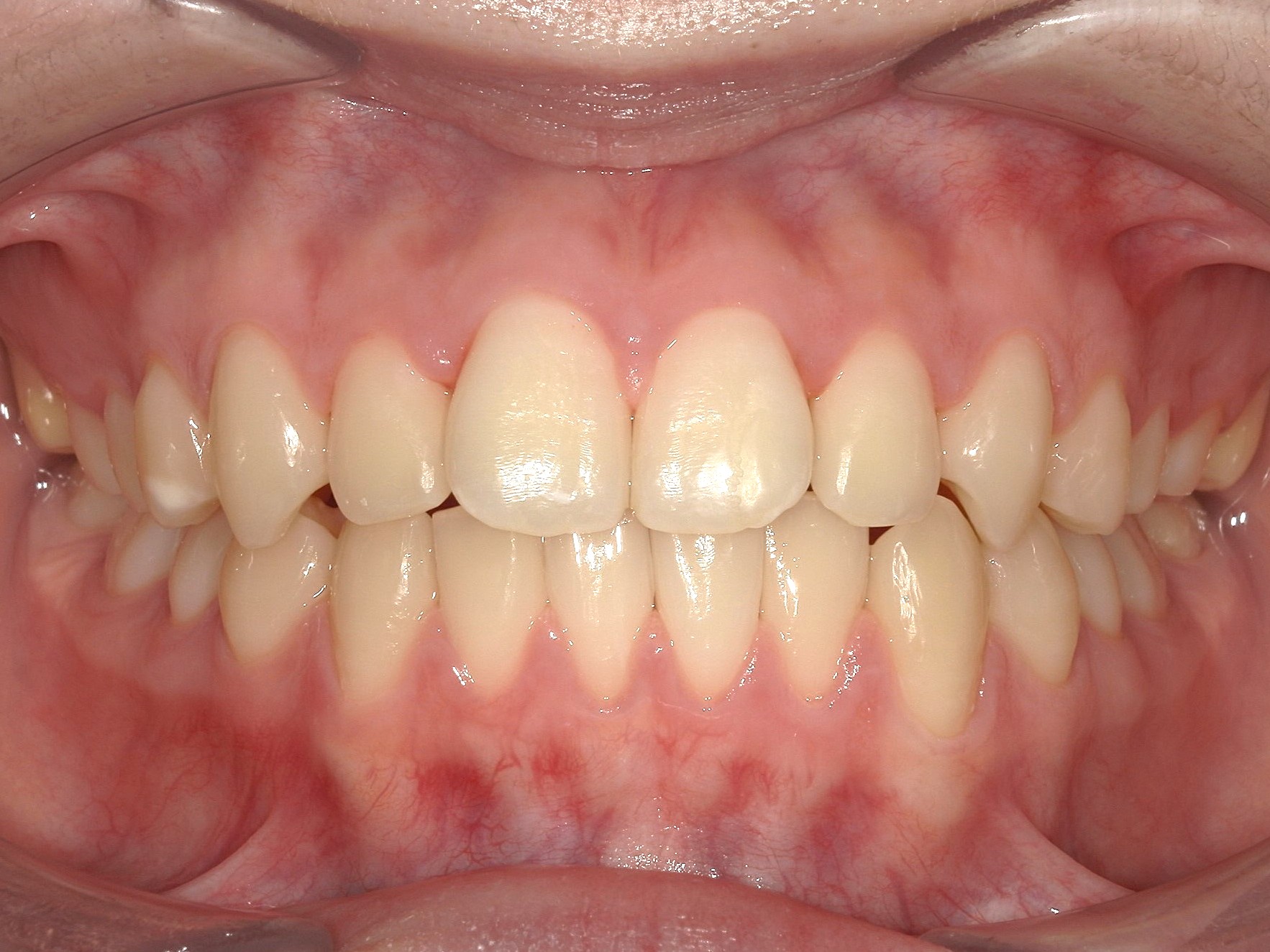 インビザライン　歯並びが気になる　叢生　ガタガタ歯並び