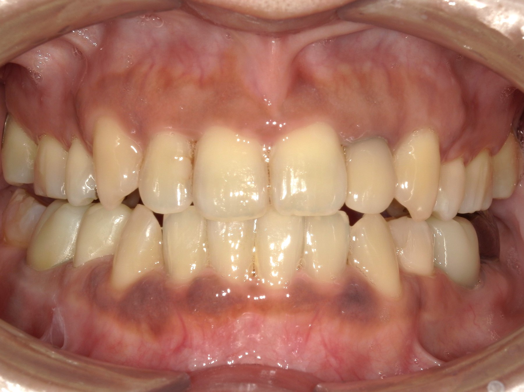 叢生　反対咬合　インビザライン　歯科矯正