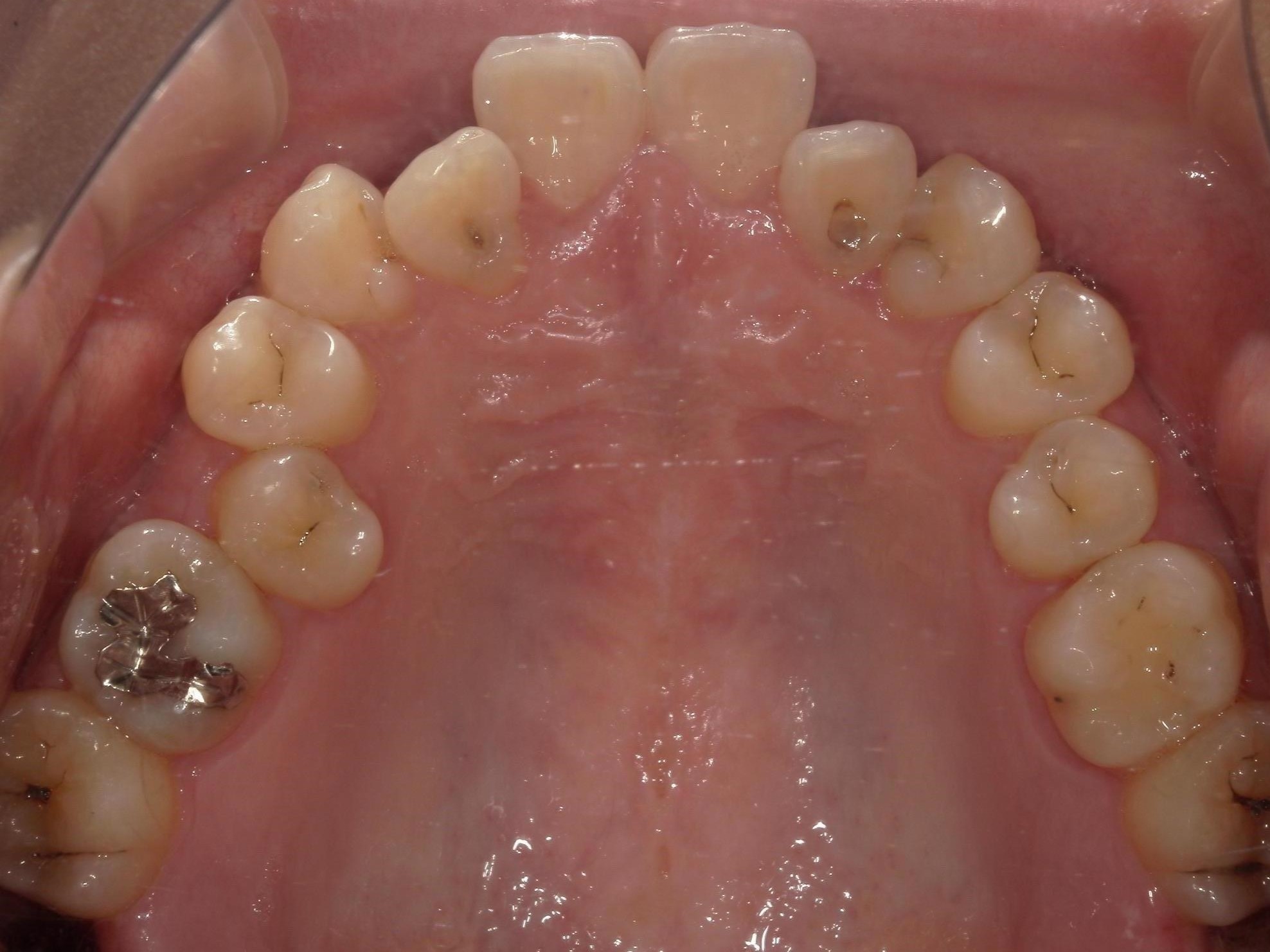 インビザライン矯正　