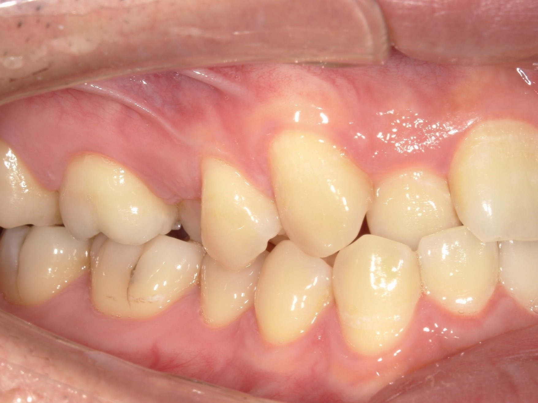 インビザライン矯正　