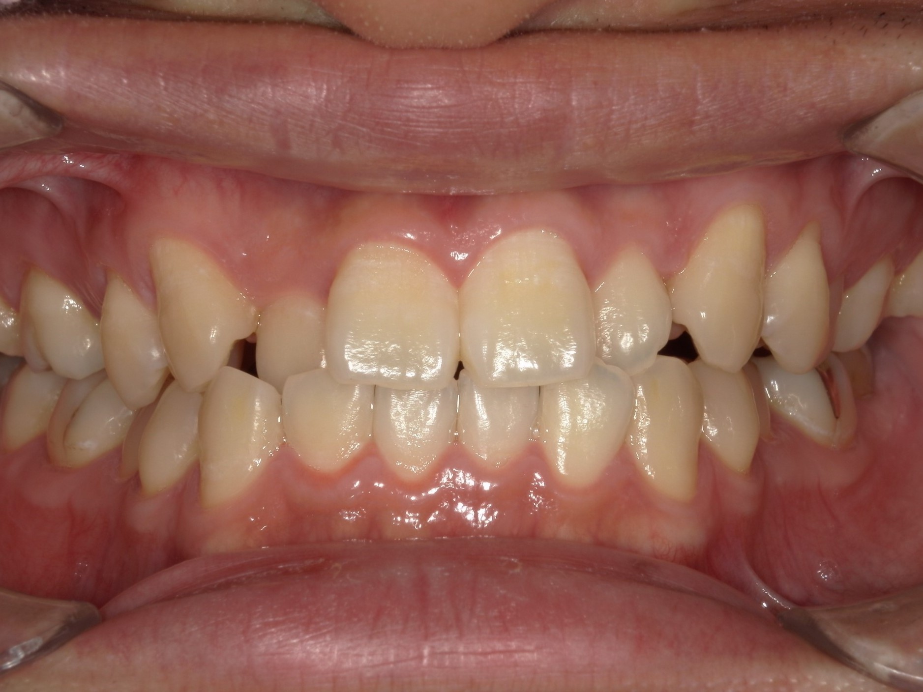 インビザライン矯正　