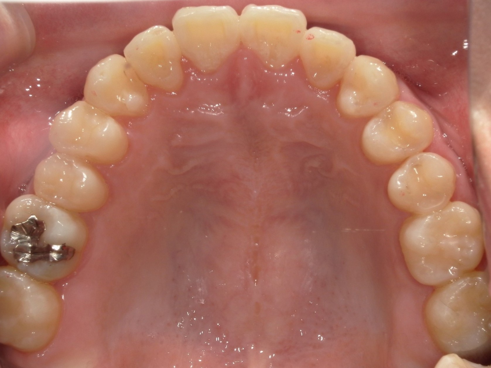 インビザライン矯正　