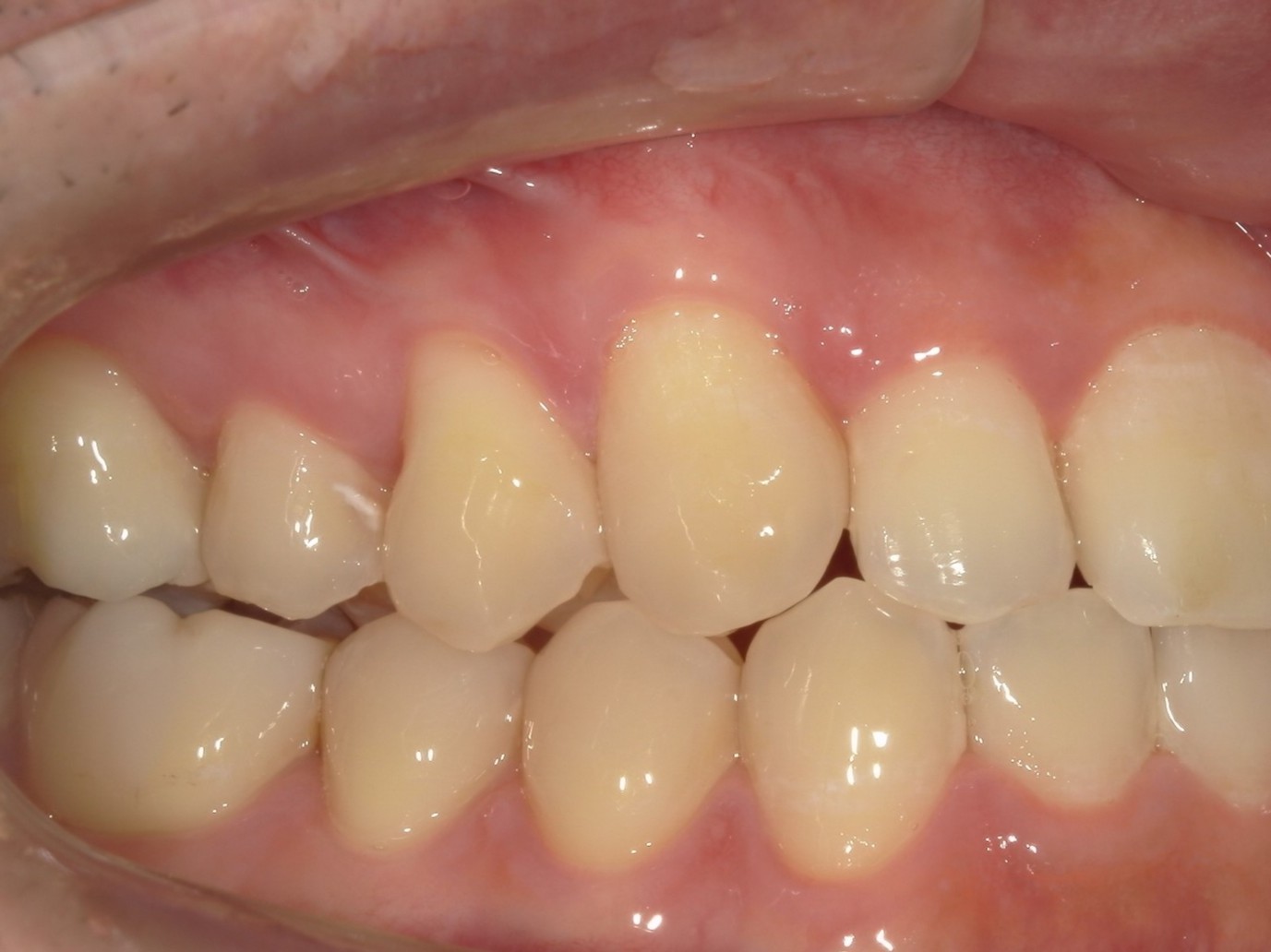 インビザライン矯正　