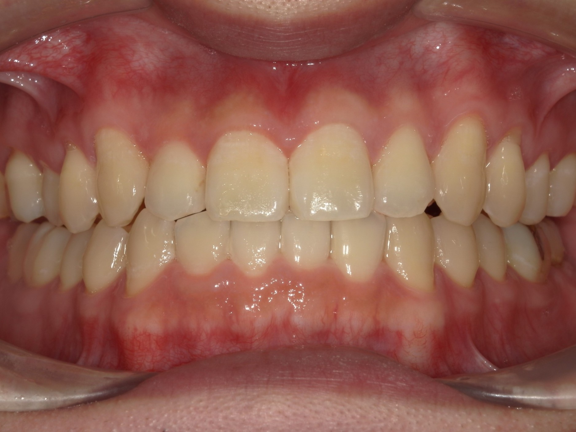 インビザライン矯正　