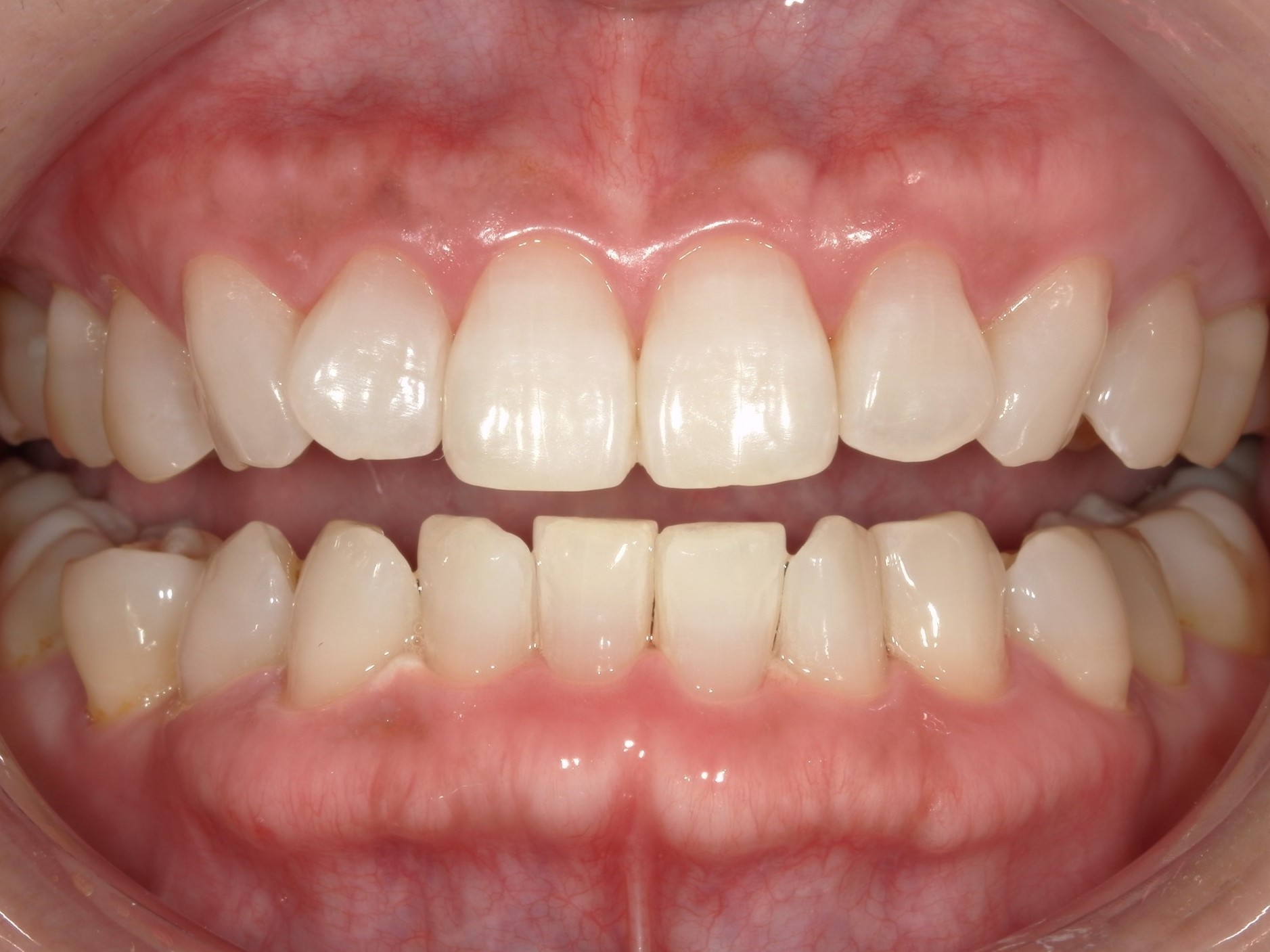 オフィスホワイトニング