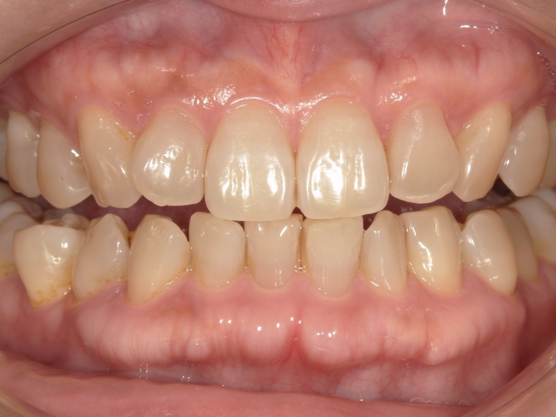 オフィスホワイトニング