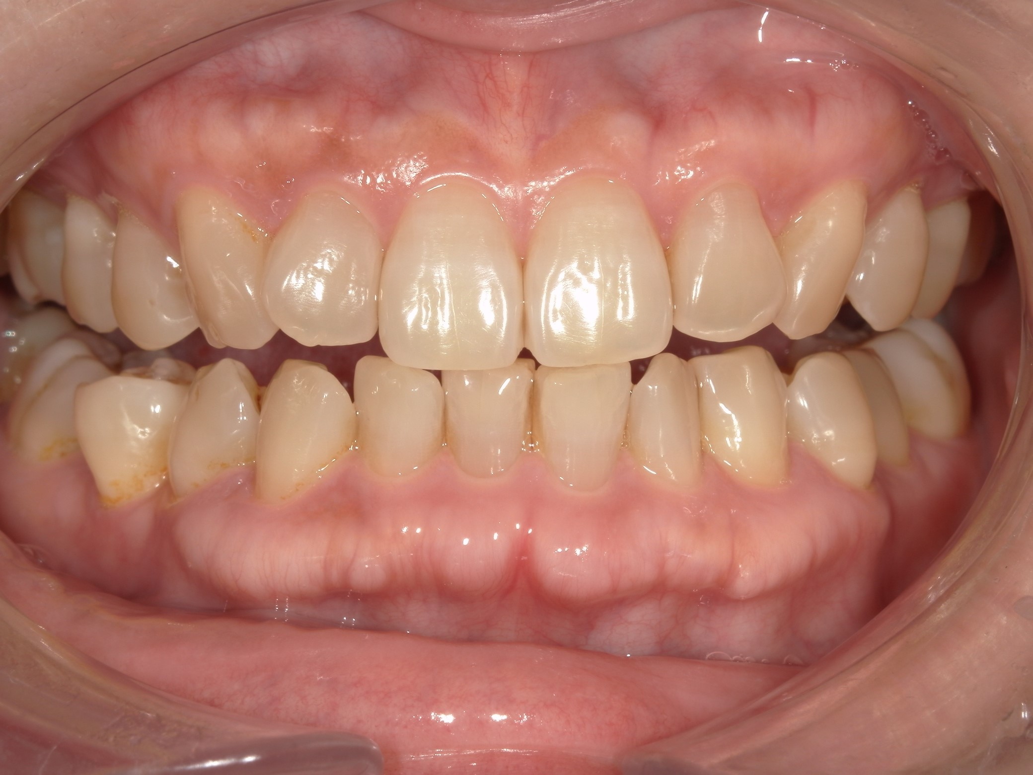 オフィスホワイトニング