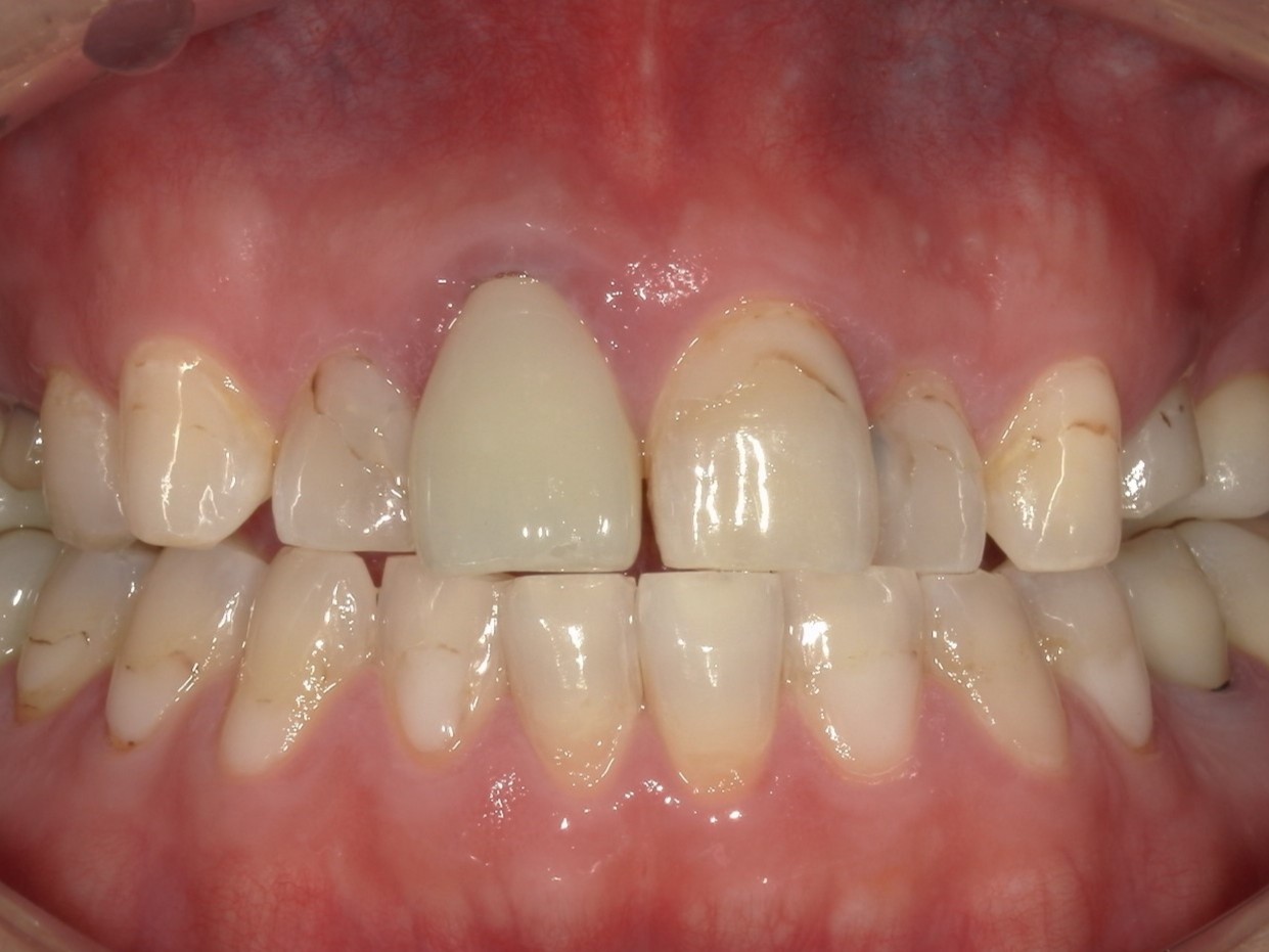 ジルコニアクラウン（自由診療の被せ物）