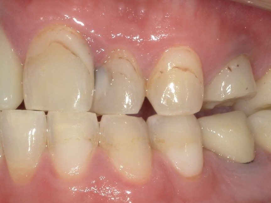 ジルコニアクラウン（自由診療の被せ物）