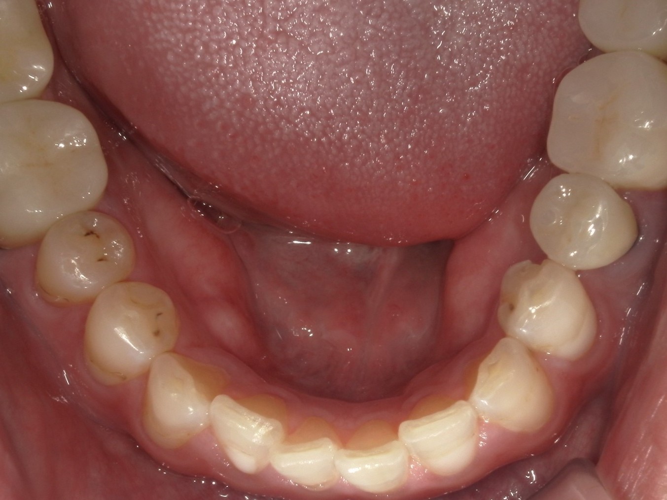 ジルコニアクラウン（自由診療の被せ物）