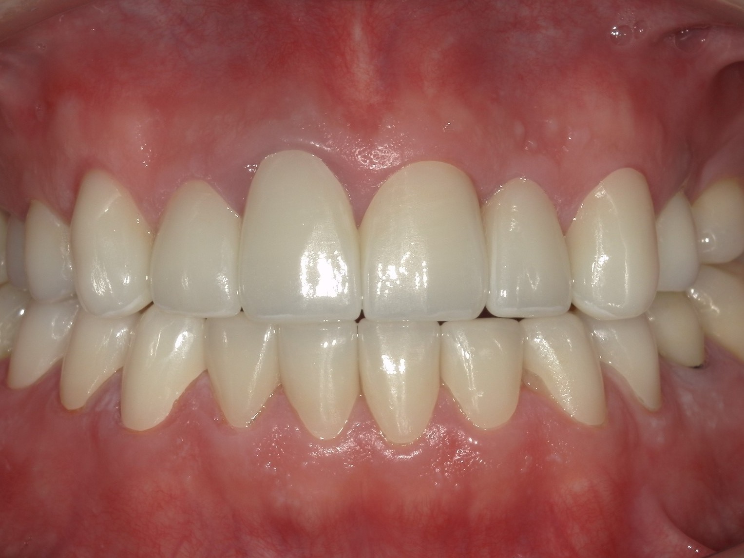 ジルコニアクラウン（自由診療の被せ物）