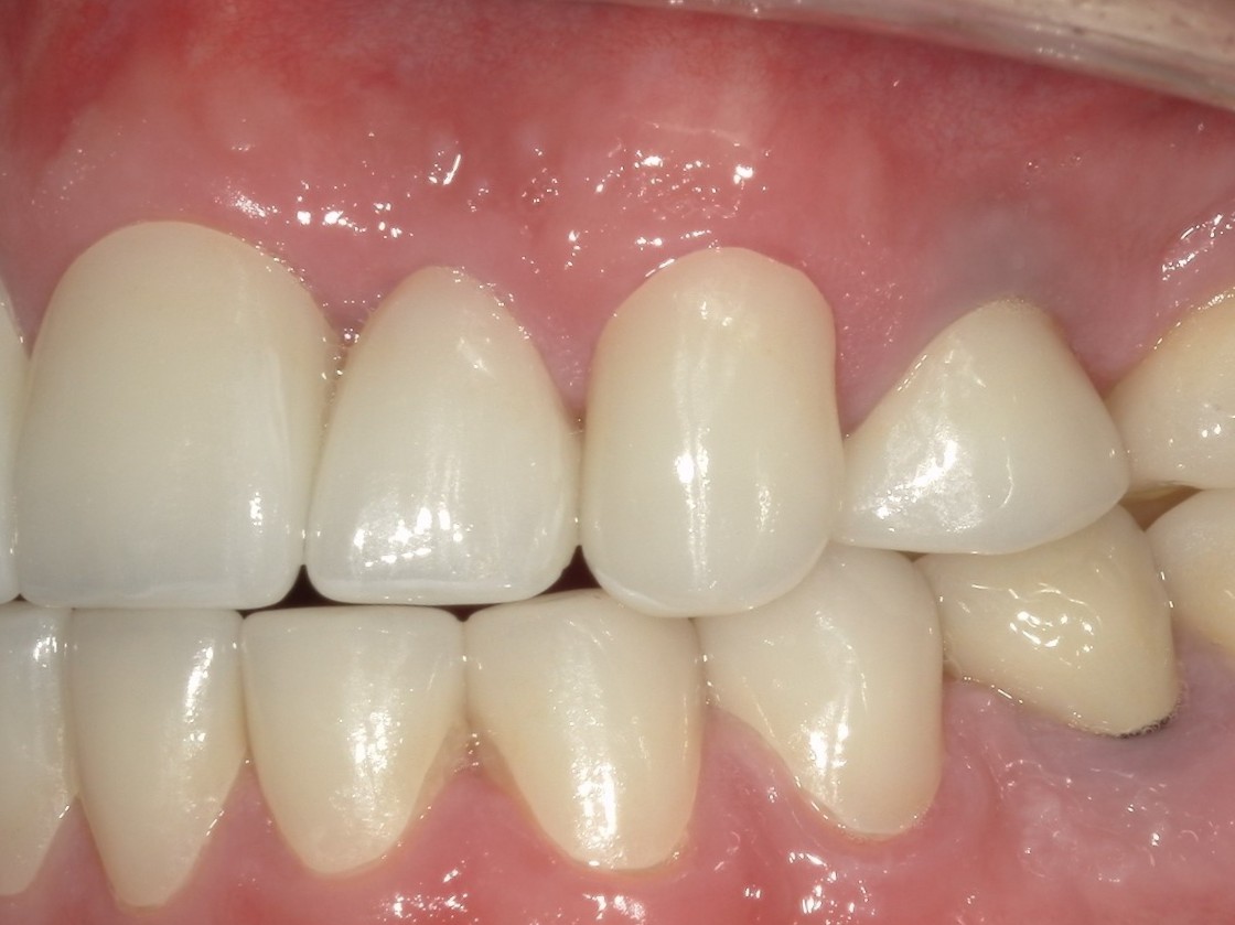 ジルコニアクラウン（自由診療の被せ物）