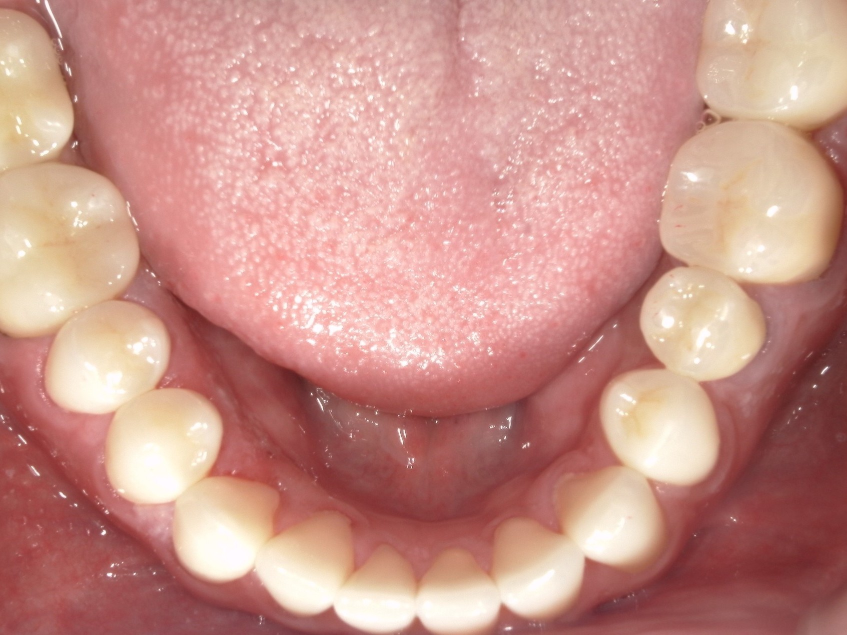 ジルコニアクラウン（自由診療の被せ物）