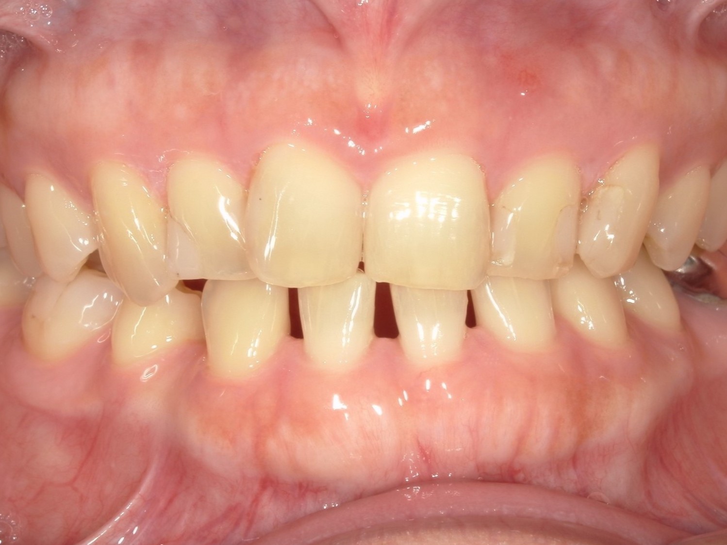 ジルコニアクラウン（自由診療の被せ物）