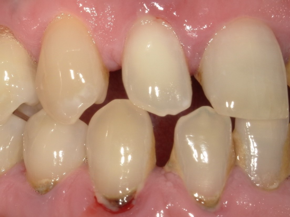 e-maxクラウン（自由診療の被せ物）