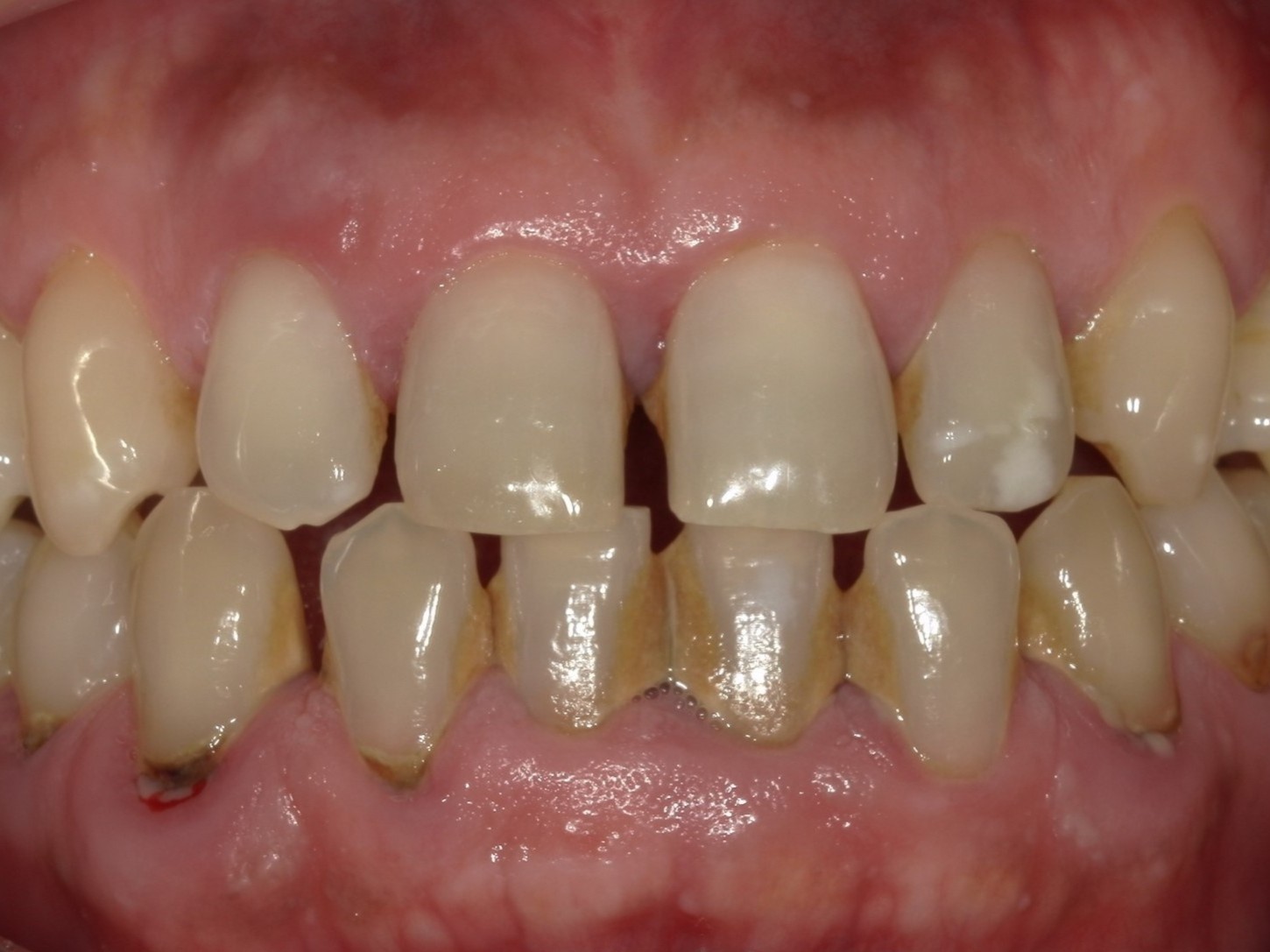 e-maxクラウン（自由診療の被せ物）