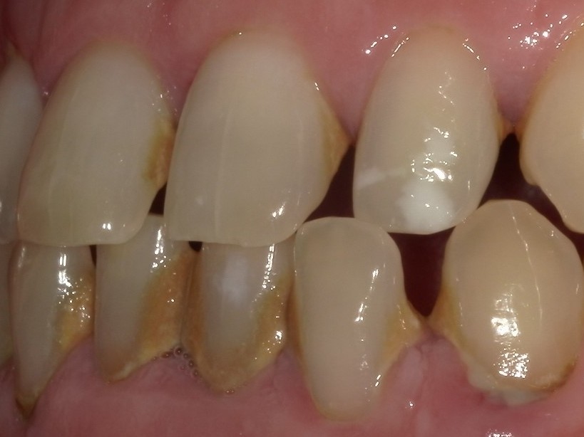e-maxクラウン（自由診療の被せ物）