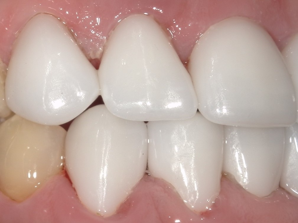 e-maxクラウン（自由診療の被せ物）