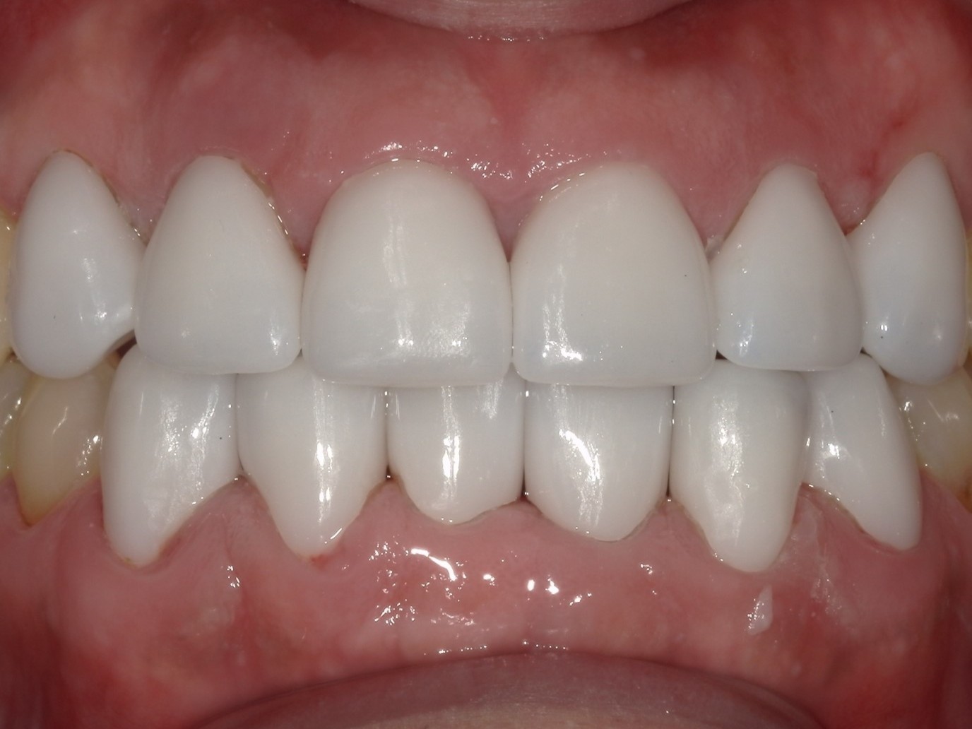 e-maxクラウン（自由診療の被せ物）