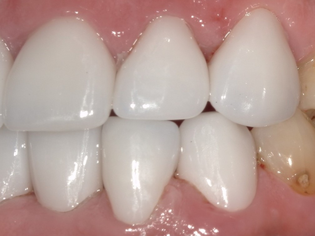 e-maxクラウン（自由診療の被せ物）