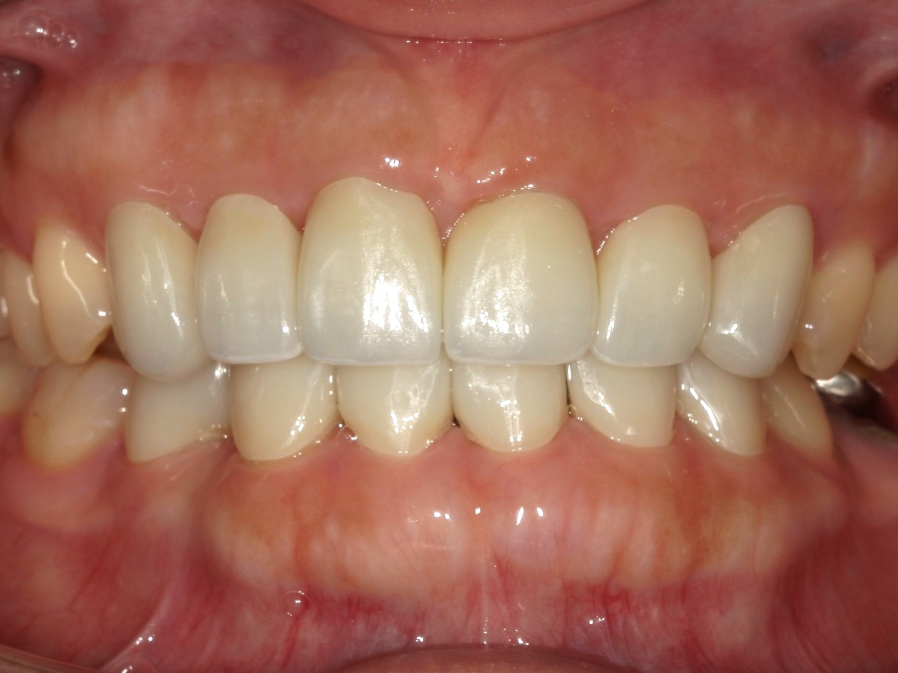 ジルコニアクラウン（自由診療の被せ物）