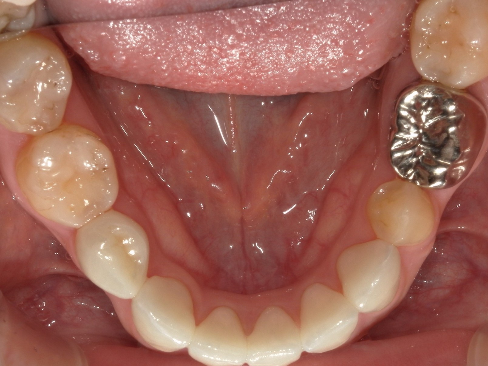 ジルコニアクラウン（自由診療の被せ物）