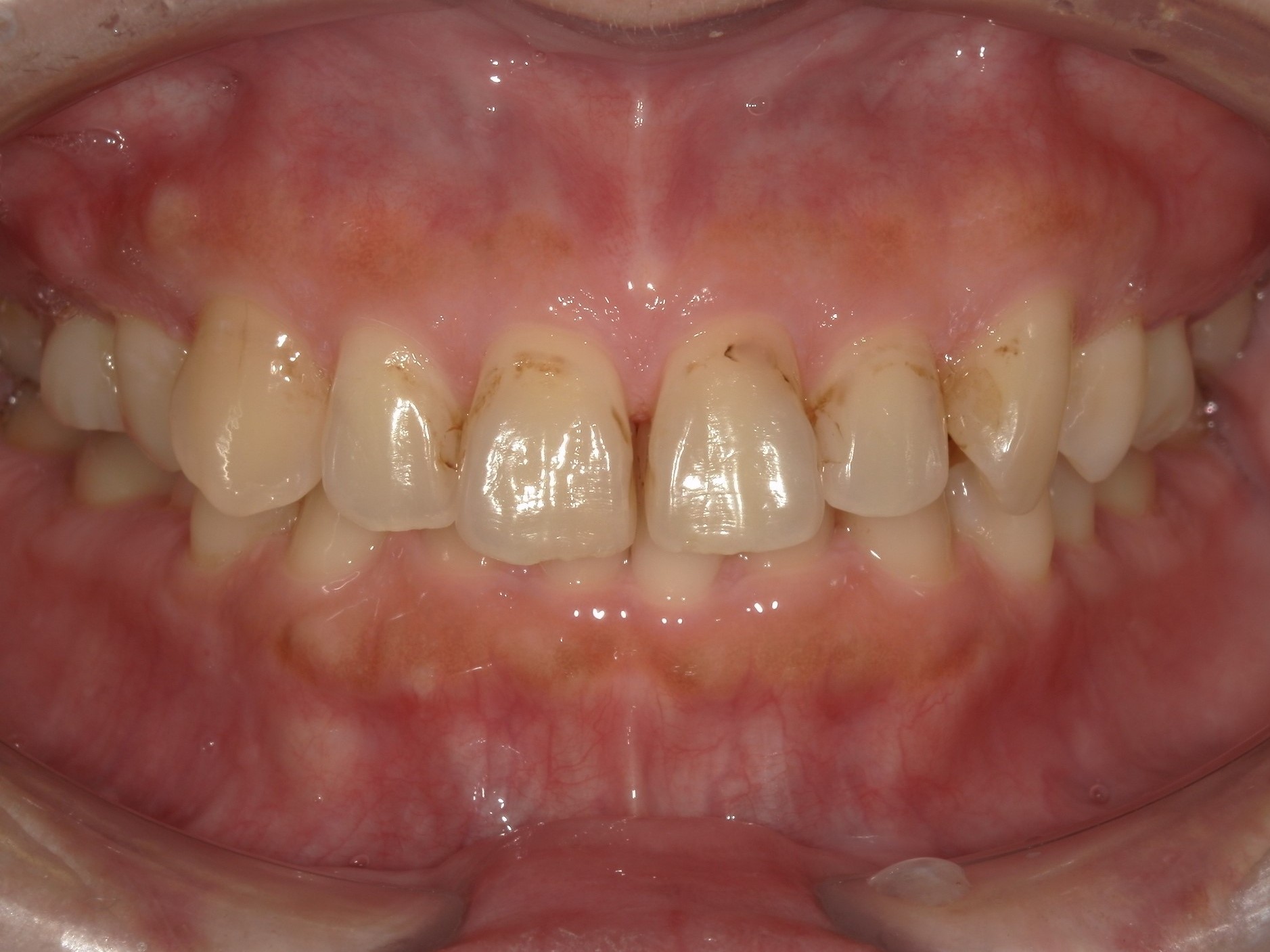 オフィスホワイトニング