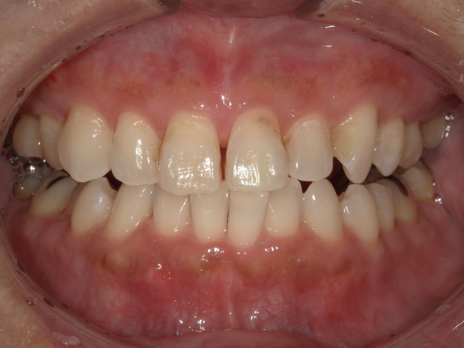 オフィスホワイトニング